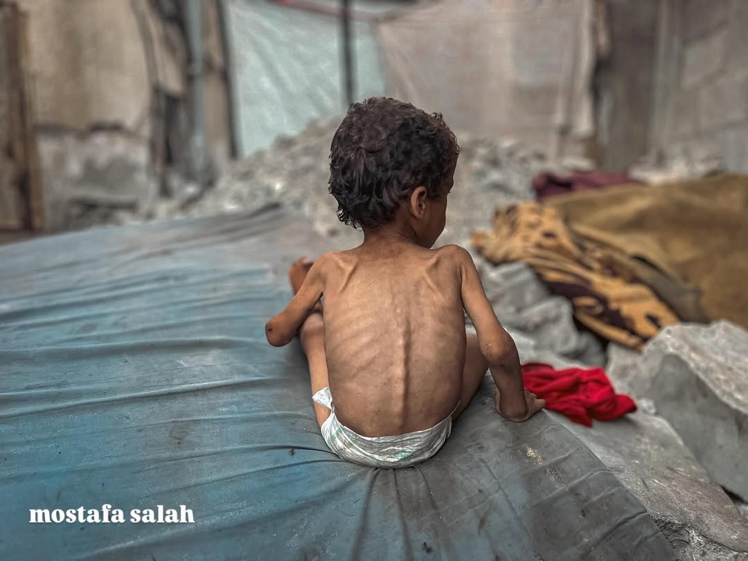 Yazan Mahmoud Atiya Abu Foul: Child Suffering from Famine in Gaza