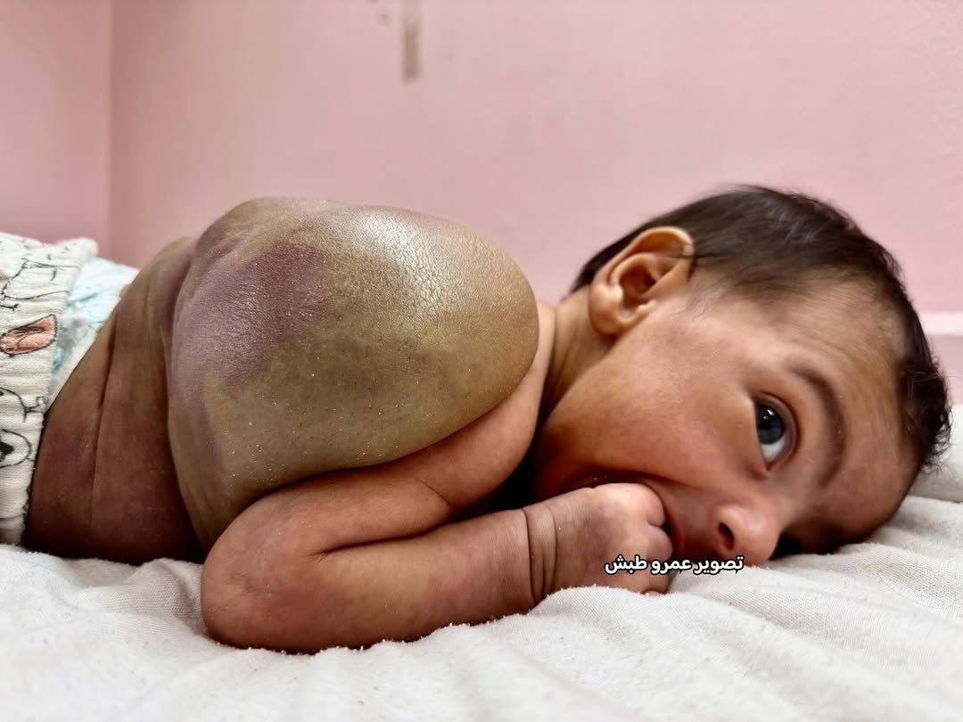 One-month-old baby with life-threatening blood cyst in Gaza