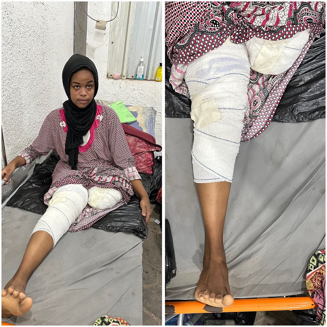 Palestinian Girl’s Health Deteriorates After Israeli Airstrike in Gaza