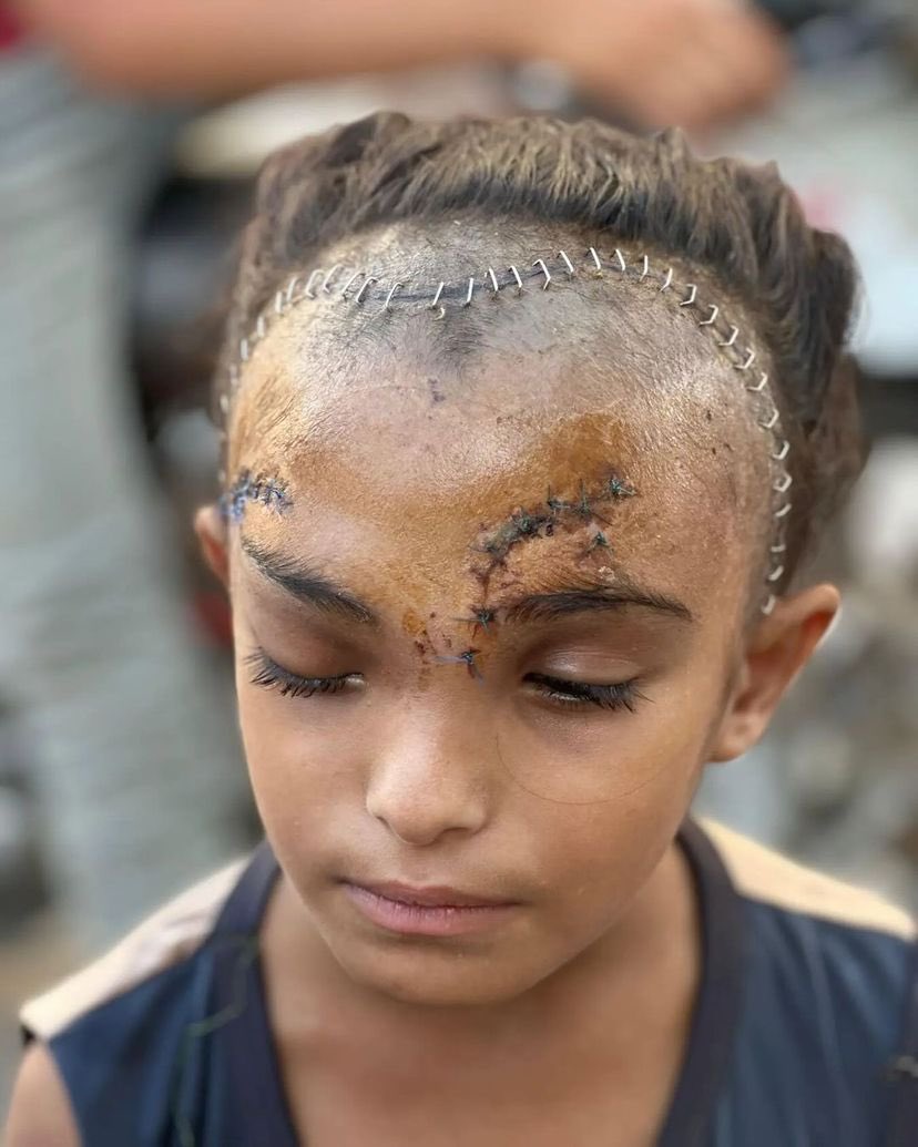 Palestinian Girl Injured in Gaza School Bombing