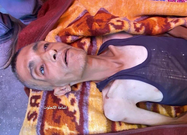 Palestinian Ahmad Hasanat Dies from Malnutrition in Gaza Blockade