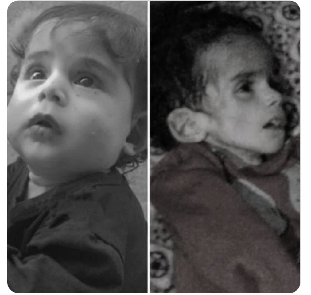 Toddler dies from starvation in Gaza amid Israeli siege