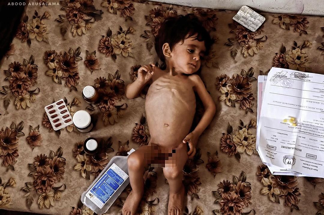 North Gaza Faces Severe Starvation Crisis Again