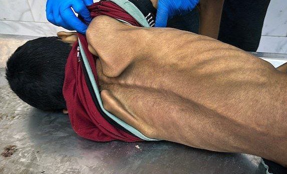 Child death from malnutrition in Gaza blockade