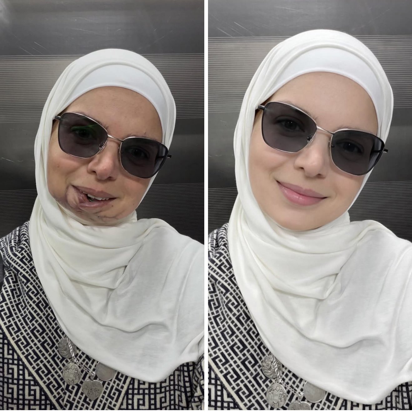 Palestinian Journalist Uses AI to Edit Airstrike Injury Photos