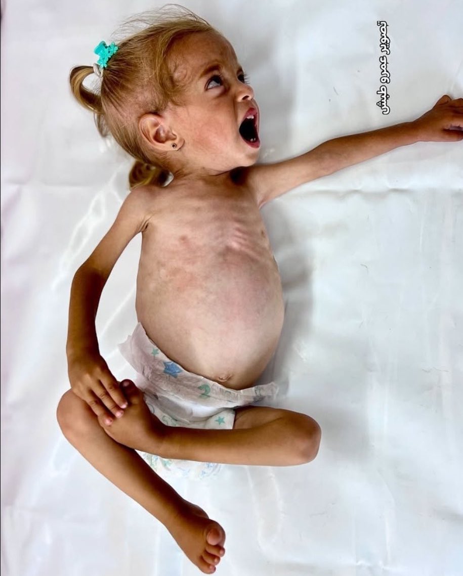Al Shifa Director Reports Disease Outbreaks in Malnourished Children