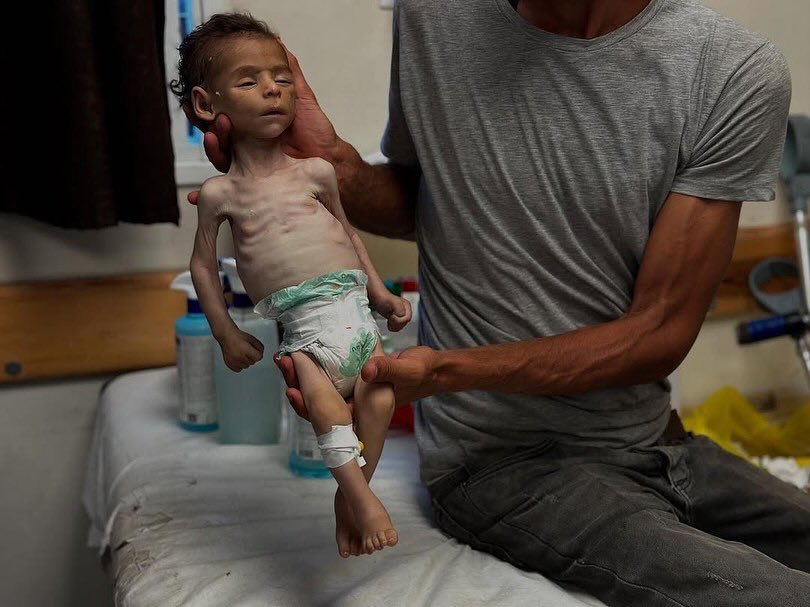 Infant Dies from Malnutrition; 72 Children Lost to Hunger