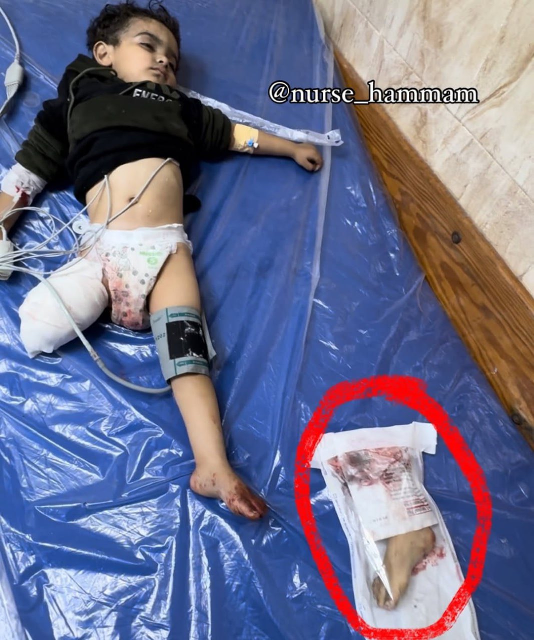 Baby loses leg in Gaza airstrike incident