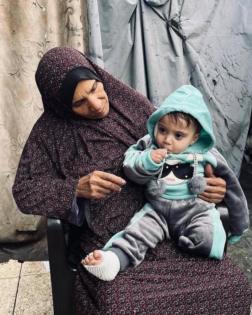 Child survivor of family bombing faces amputation and burns
