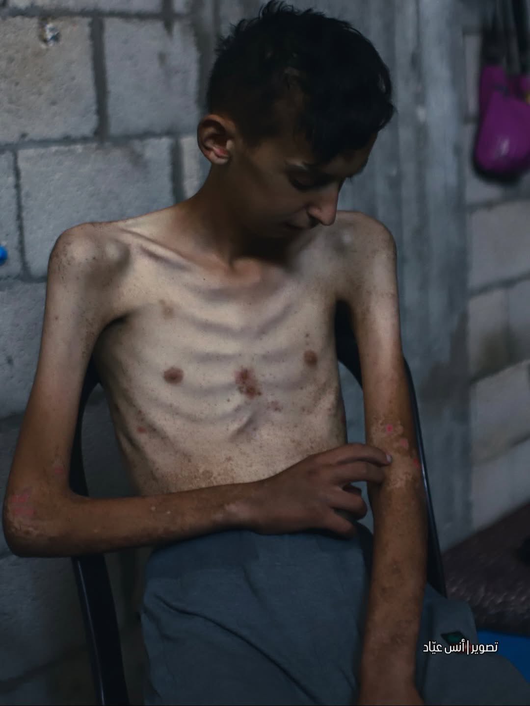 Child Death from Celiac Disease and Malnutrition in Gaza