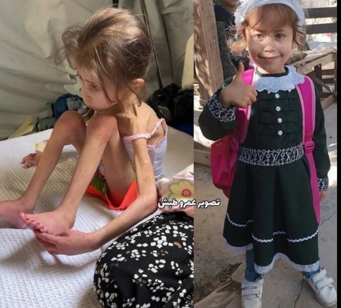 Children Starving to Death in Gaza Deliberately