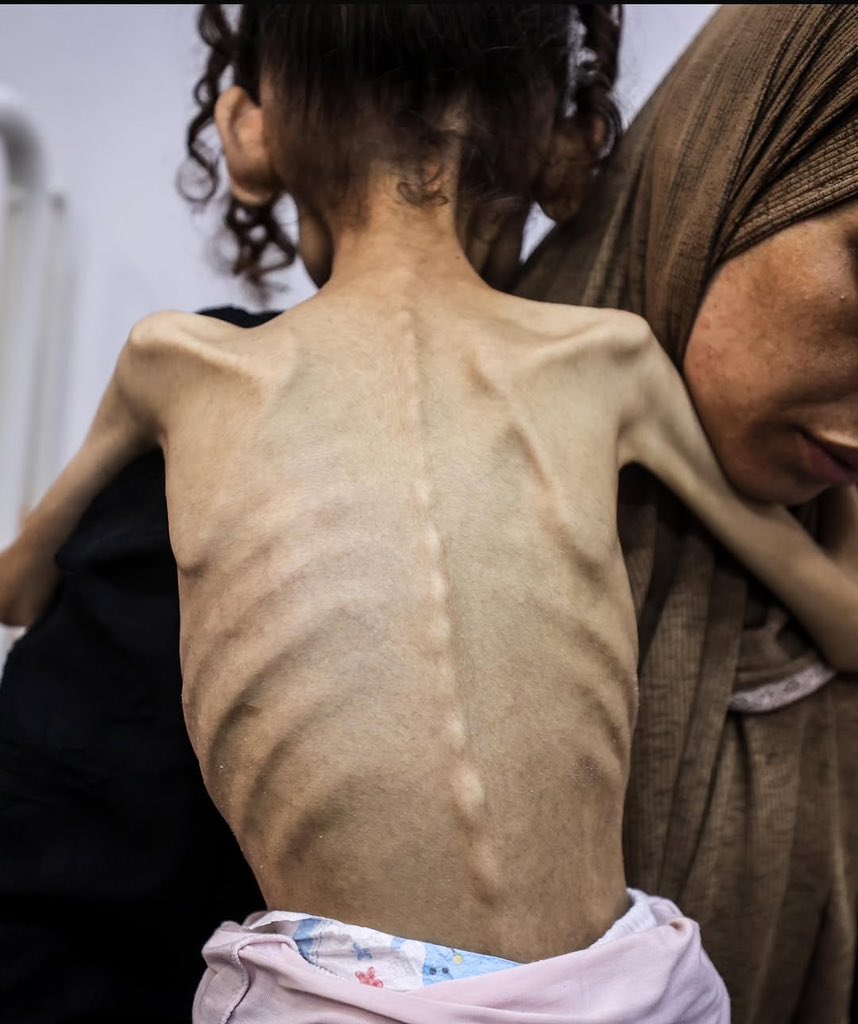 Israel accused of killing and starving Gaza children