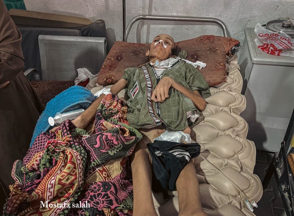 Child Suffering from Malnutrition and Hunger Amid Ongoing Siege