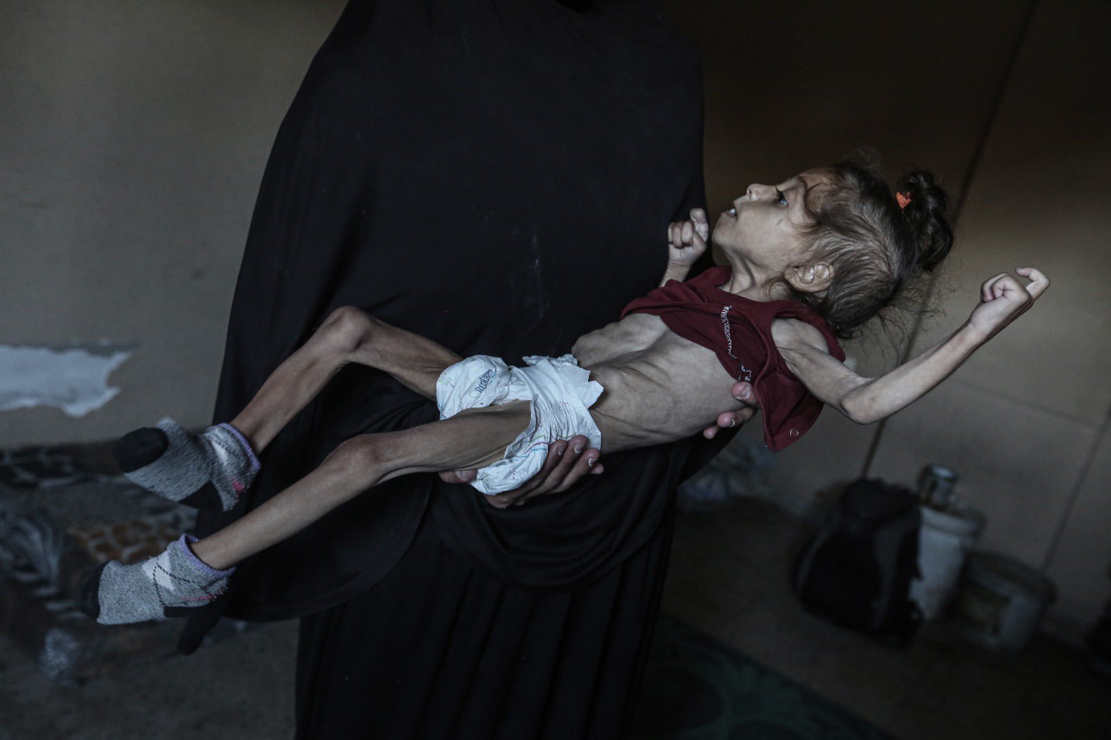 Child malnutrition and medical neglect in Gaza displacement camp