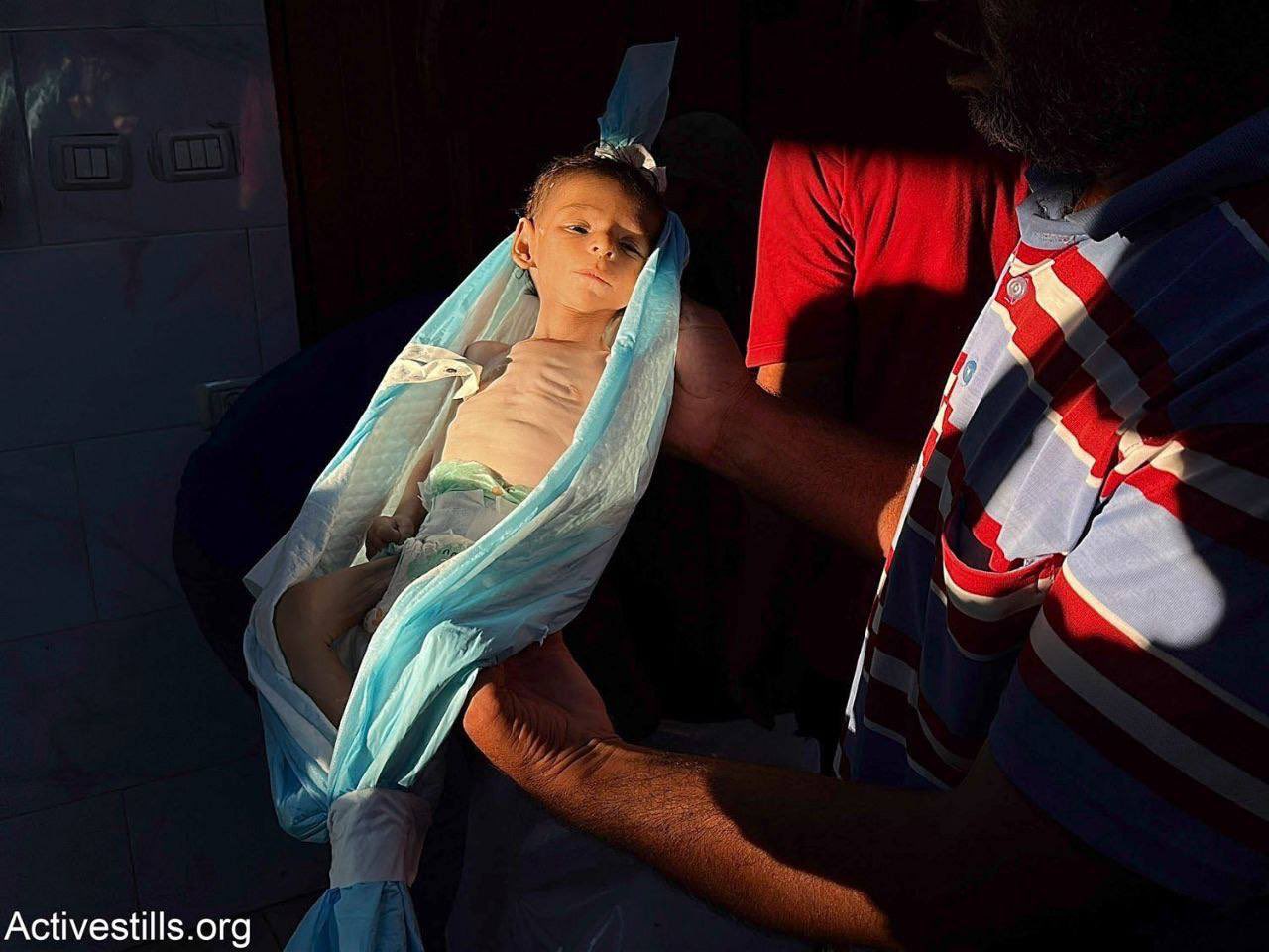 Gaza MOH Director Reports 18 Deaths from Dehydration and Malnutrition
