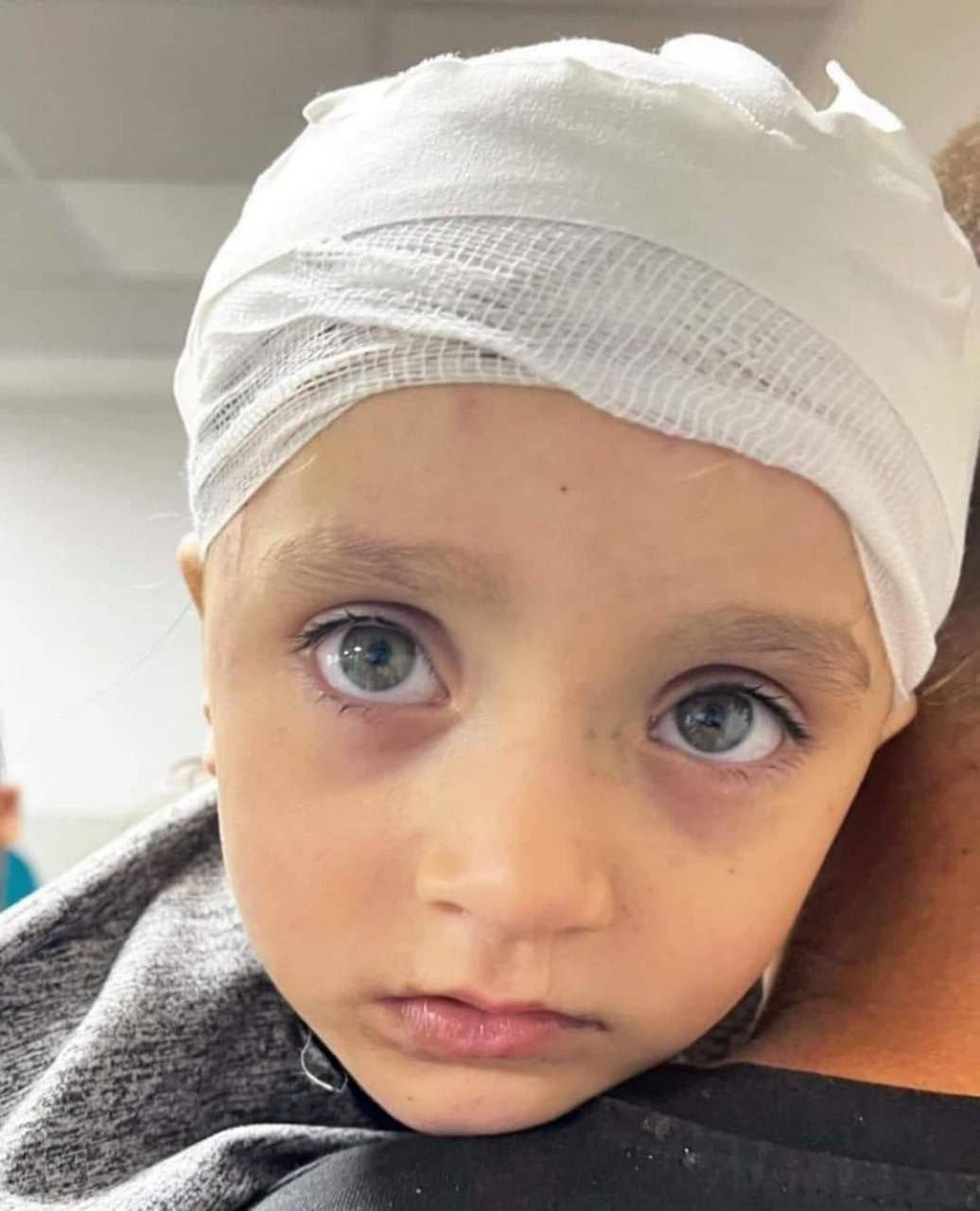 Palestinian Girl Suffers Head Injury From Israeli Airstrike in Gaza
