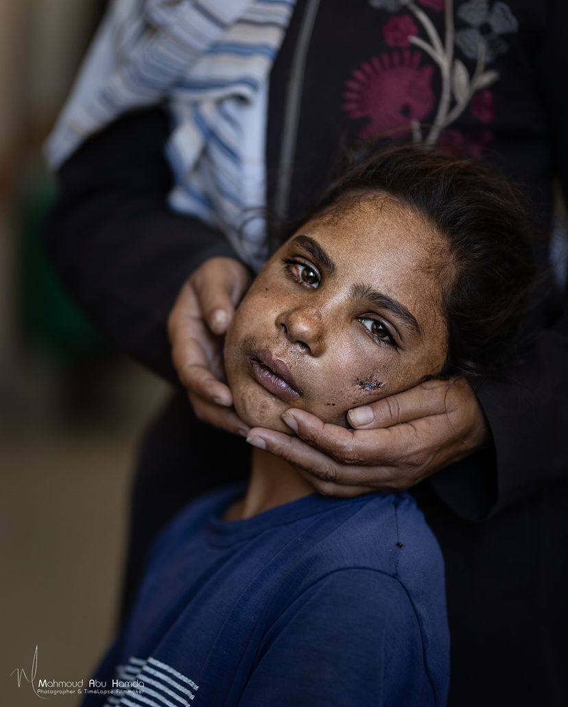 Palestinian Girl Injured by Israeli Drone Strike in Gaza