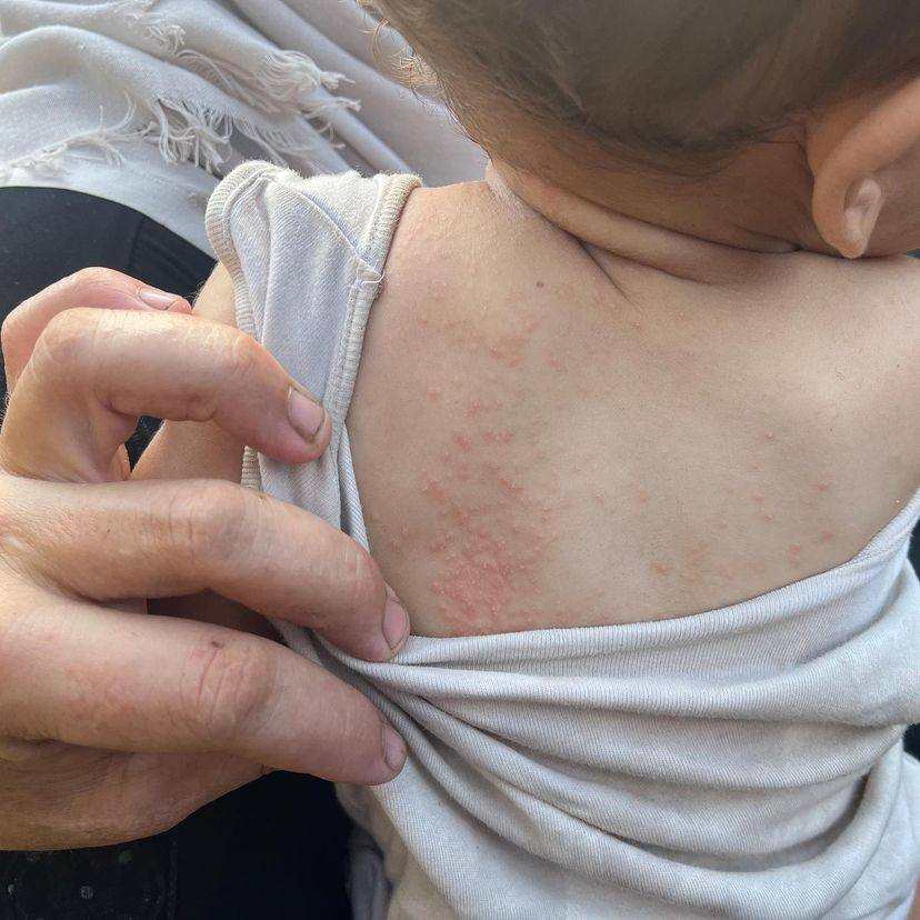 Skin diseases spread in Gaza camps due to blocked hygiene access
