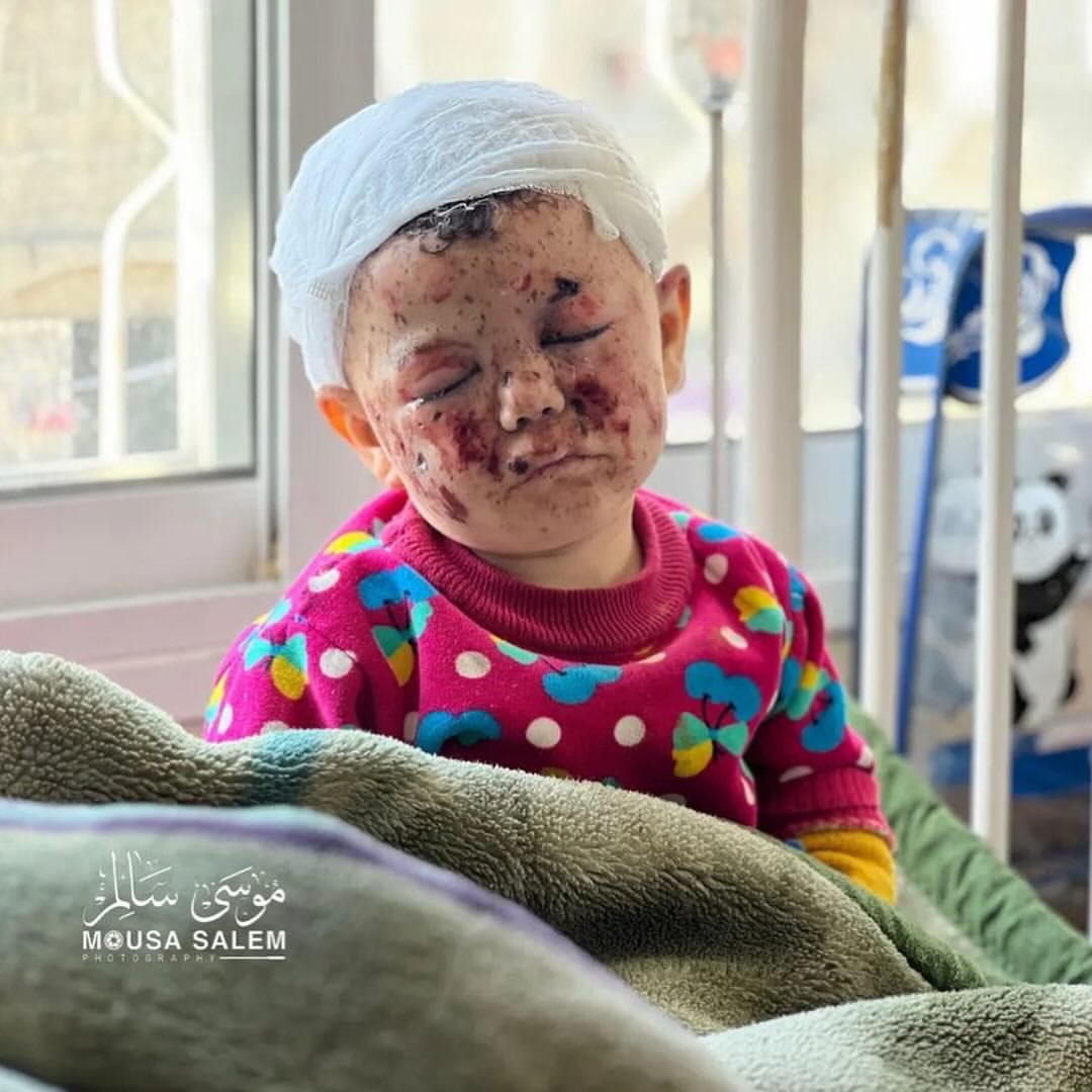 Child Mousab Hams burns, injuries from Israeli bombing in Gaza