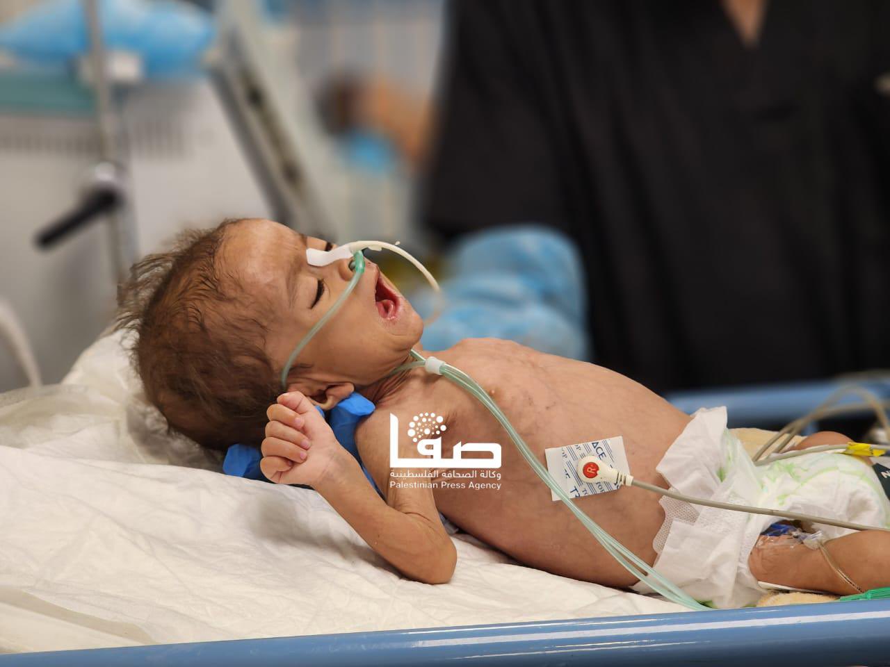 Malnutrition and Dehydration Crisis in Gaza Hospitals