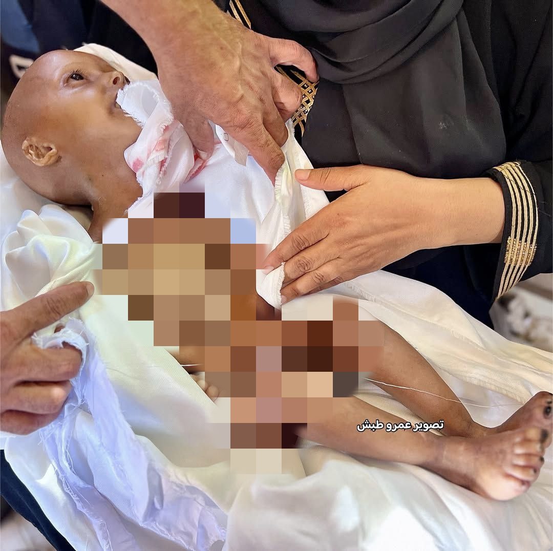 Four-year-old Hala Raed Al-Hanadi dies from malnutrition Gaza blockade