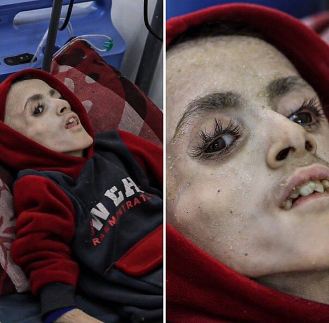 Picture Shows Famine Crisis in Northern Gaza