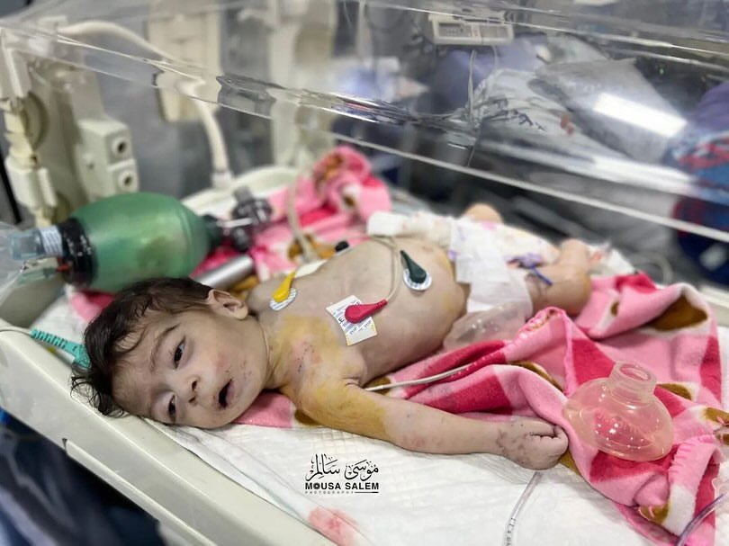 Baby girl Dalia dies from starvation and dehydration in Gaza