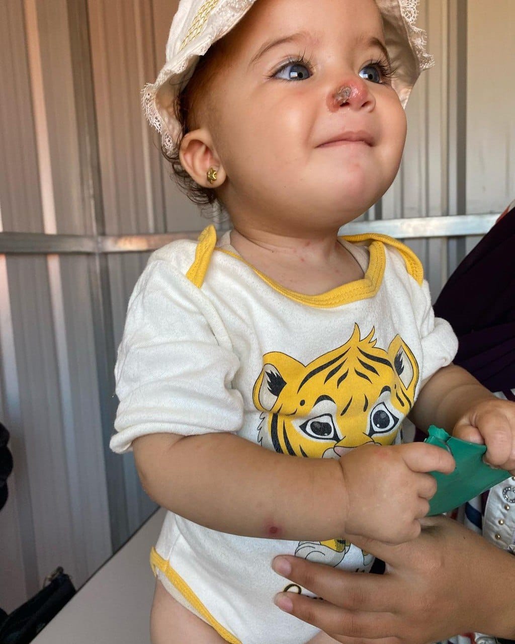 Displaced Palestinian Girl Suffers from Skin Infections in Gaza Shelters