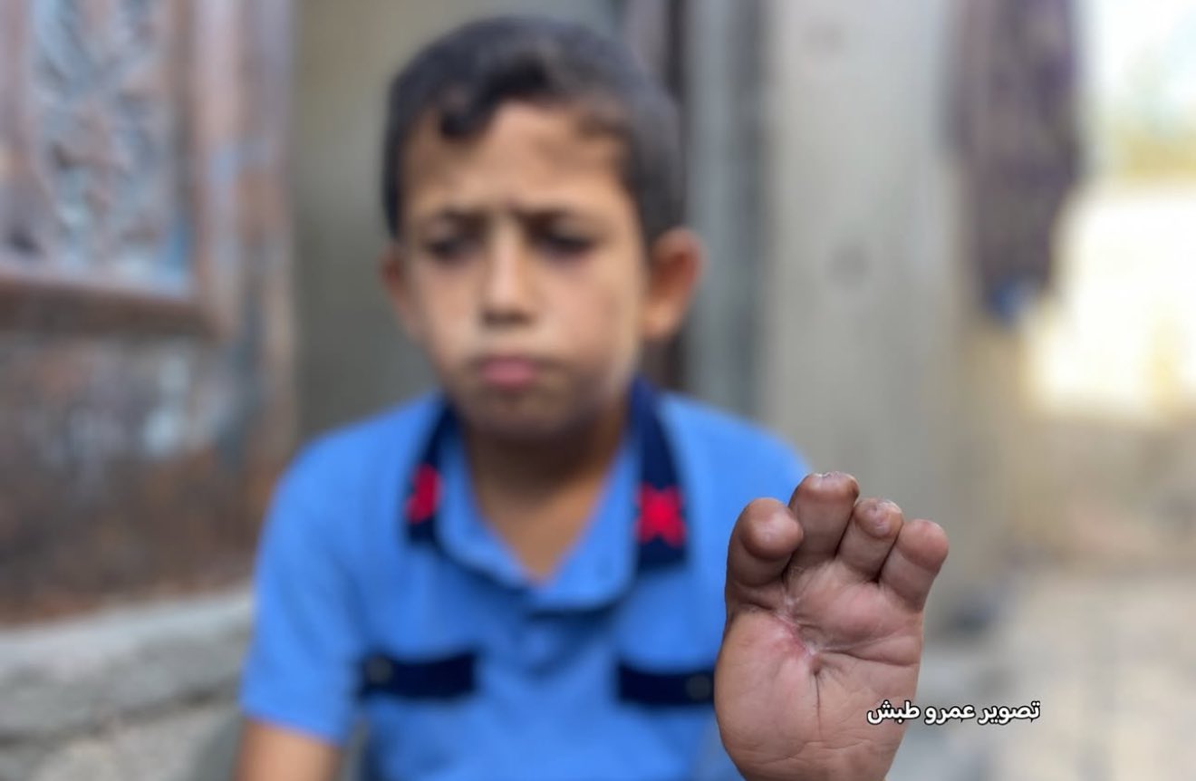 13-Year-Old Palestinian Boy Severely Injured in Israeli Airstrike