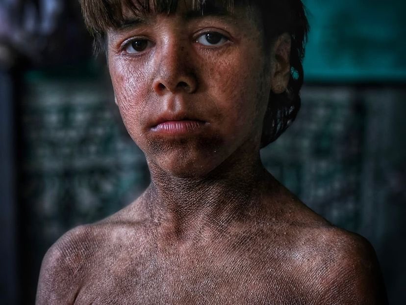 Gaza siblings suffer from aggravated psoriasis due to war and blockade