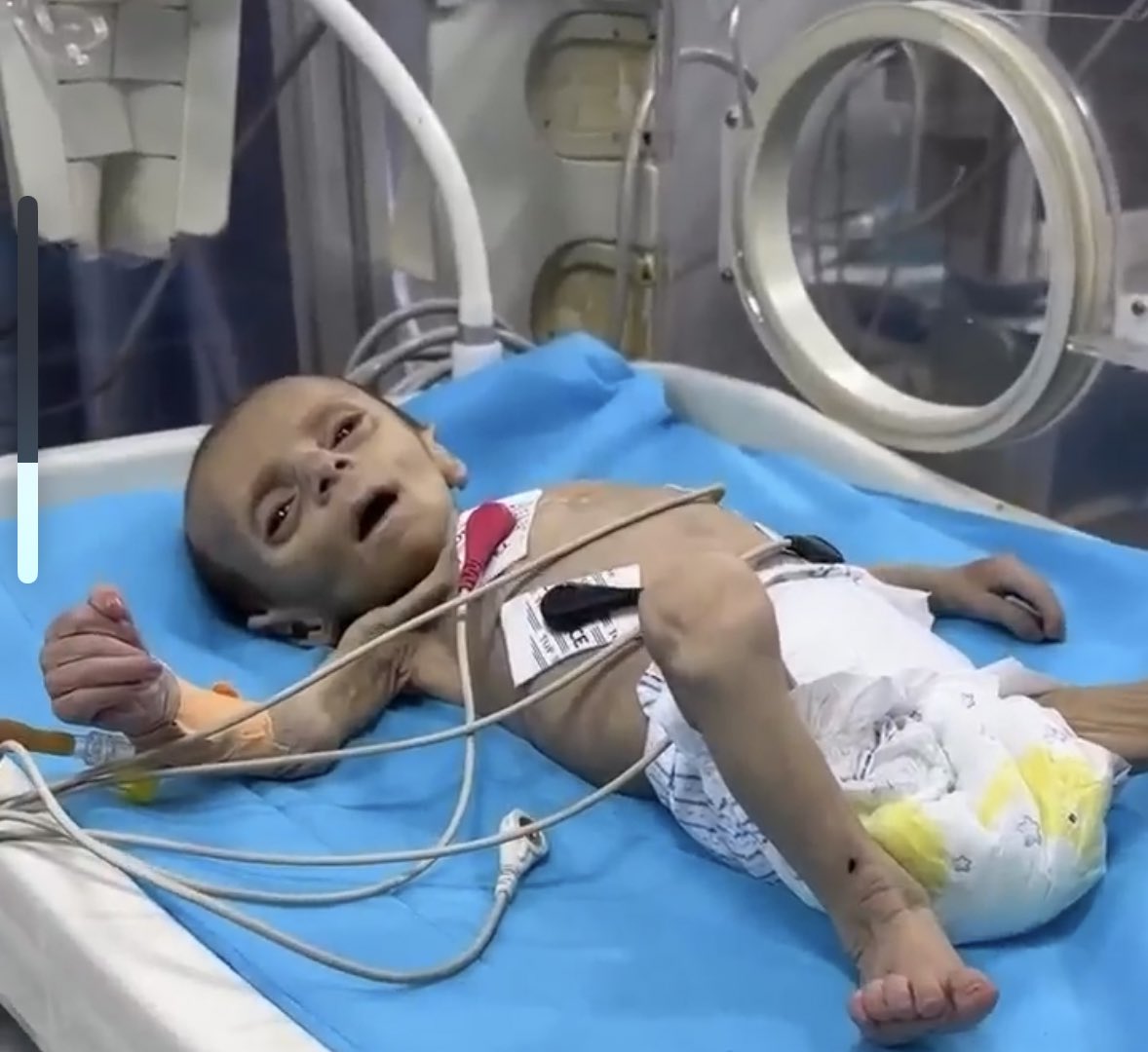 Forced Starvation Crisis Deepens in Gaza