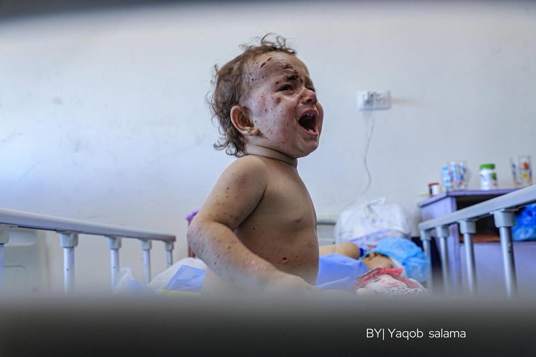 Gaza’s children suffer wounds their bodies cannot endure