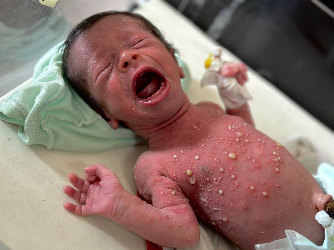 One Week Old Infant Faces Severe Malnutrition Crisis Gaza