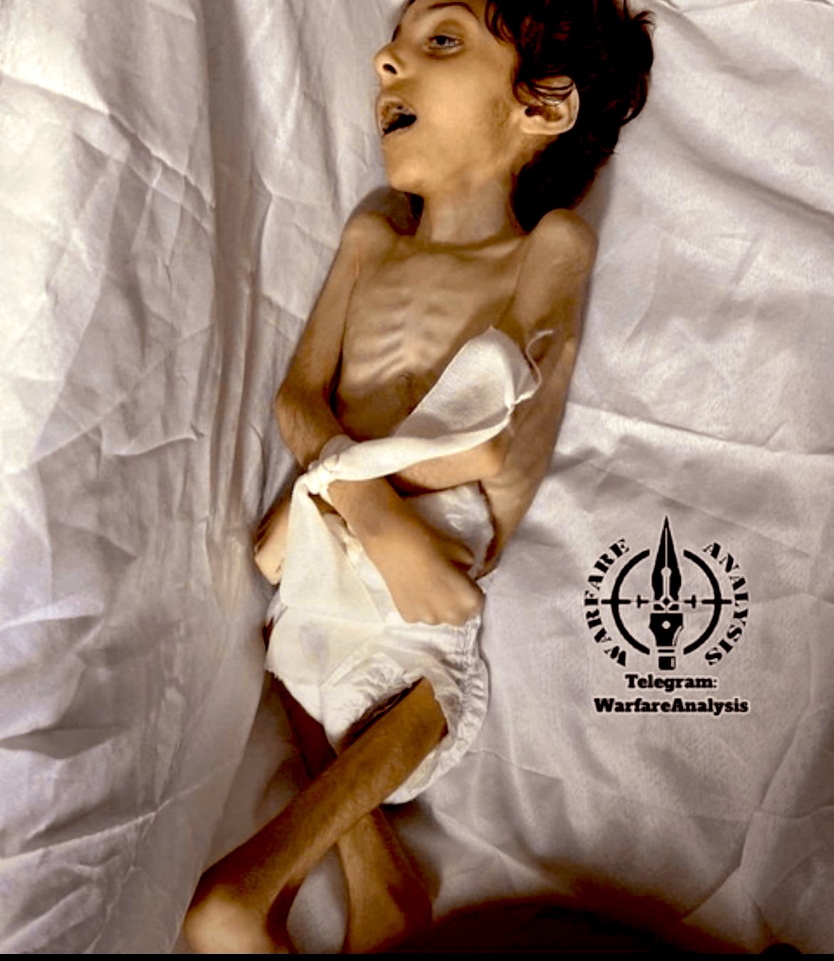 Gaza mortality underreporting due to hospital capacity collapse