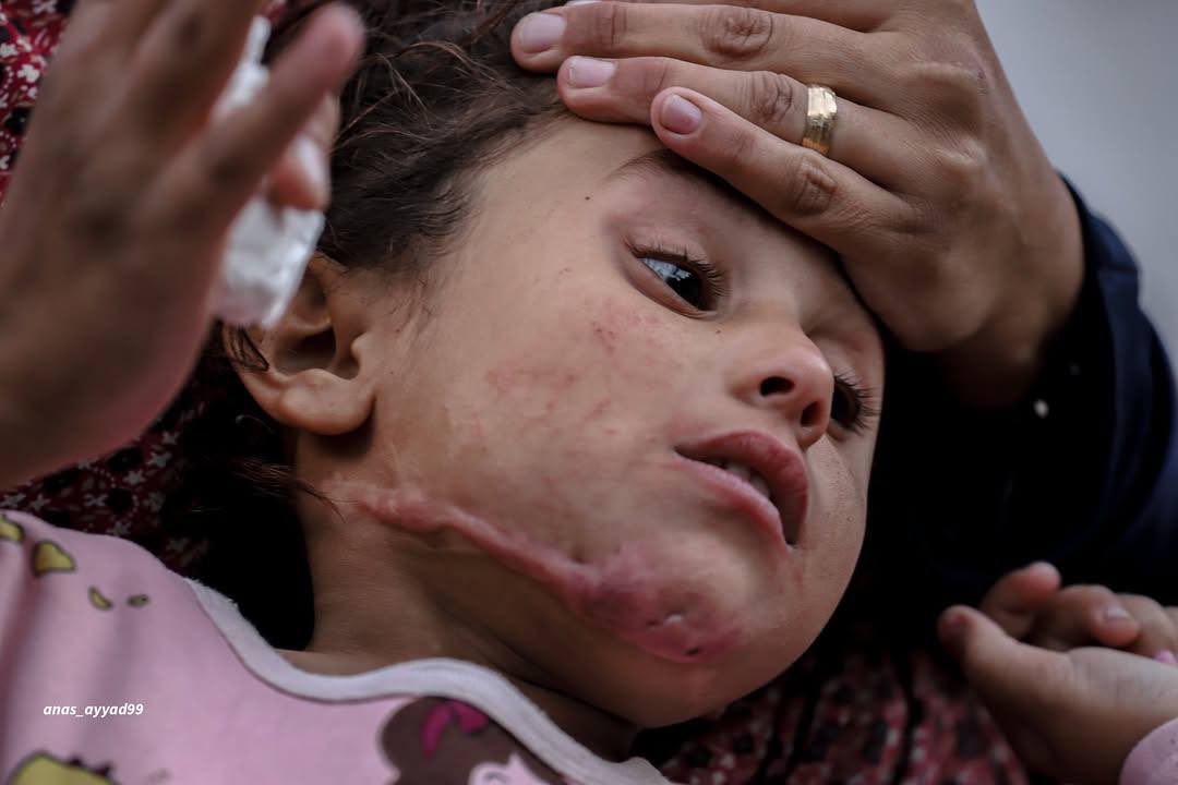 Child Rital needs urgent treatment after Israeli drone attack