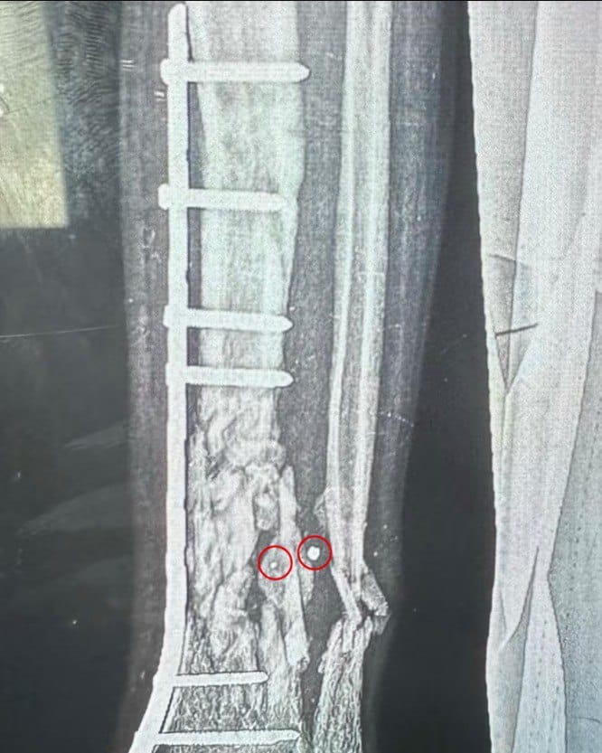 Foreign surgeons report Israeli weapons causing severe injuries to Gaza children