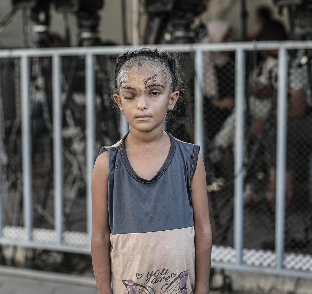 Seven-Year-Old Palestinian Child Wounded in Gaza Airstrike