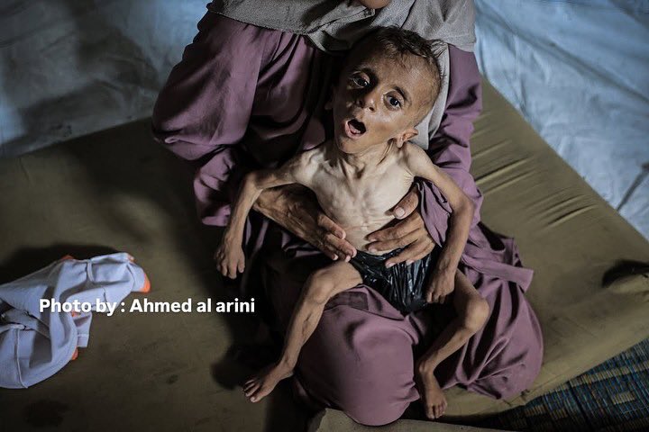 Gaza’s Children Starving Amid Humanitarian Crisis