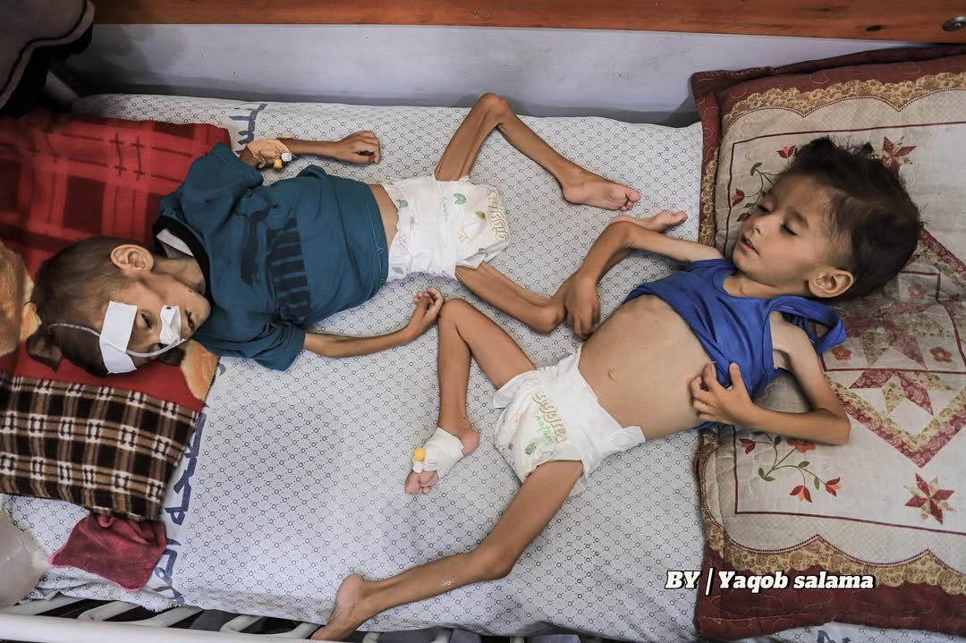 Children’s Malnutrition Crisis Escalates Amid Global Indifference