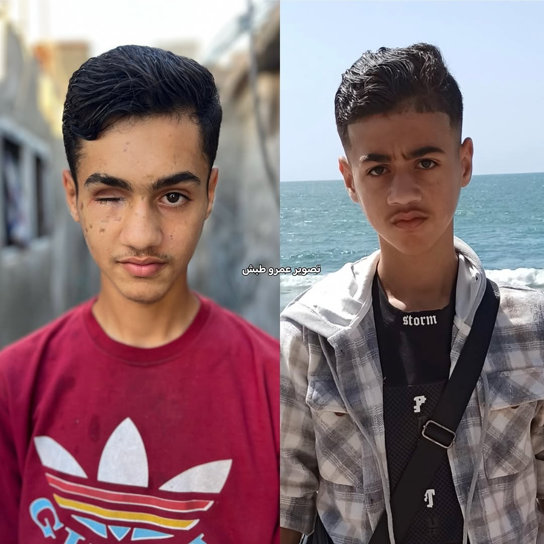 15-Year-Old Boy Loses Eye in Explosion, Needs Medical Care