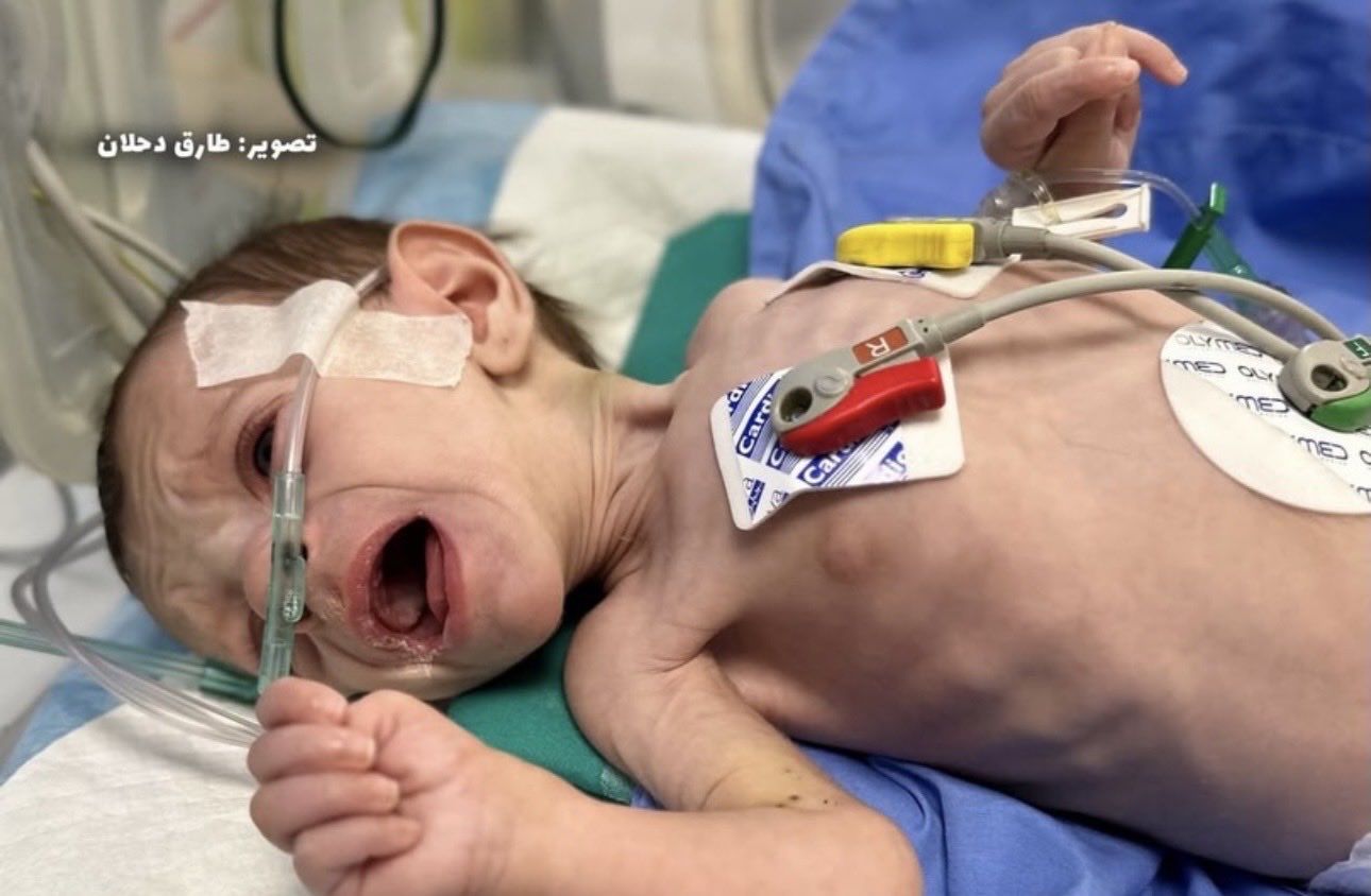 Infant Alma Abu Rida Fights Severe Malnutrition and Lung Infections Gaza