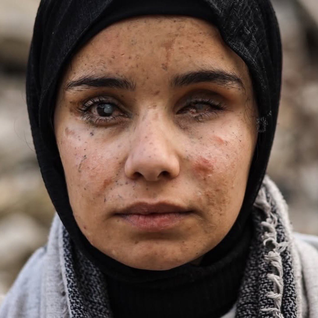 17-year-old Gaza girl lost leg and eye in Israeli attack