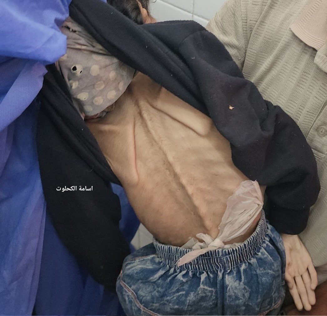Child Dies from Hunger in Gaza Amid Ongoing Siege