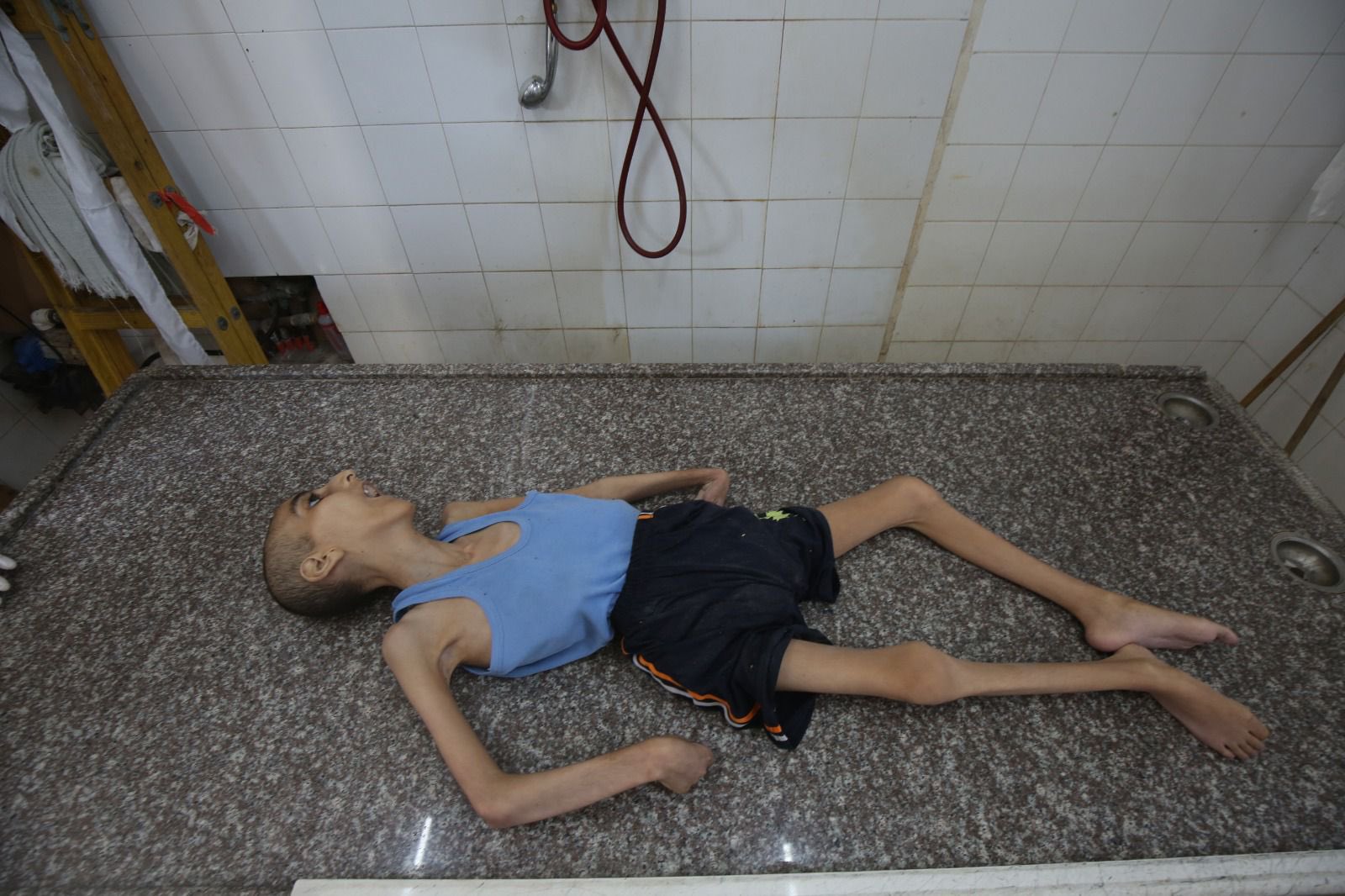 15-Year-Old Dies From Malnutrition in Gaza