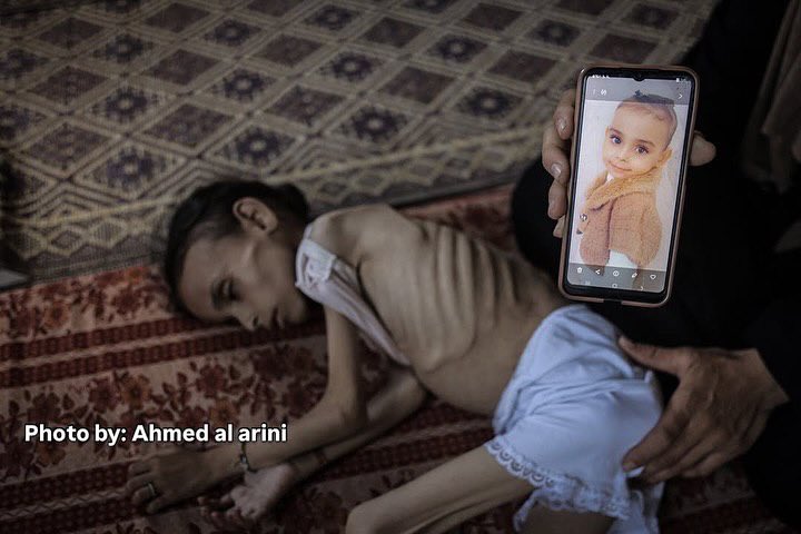 Nine-Year-Old Girl Unable to Walk from Severe Malnutrition