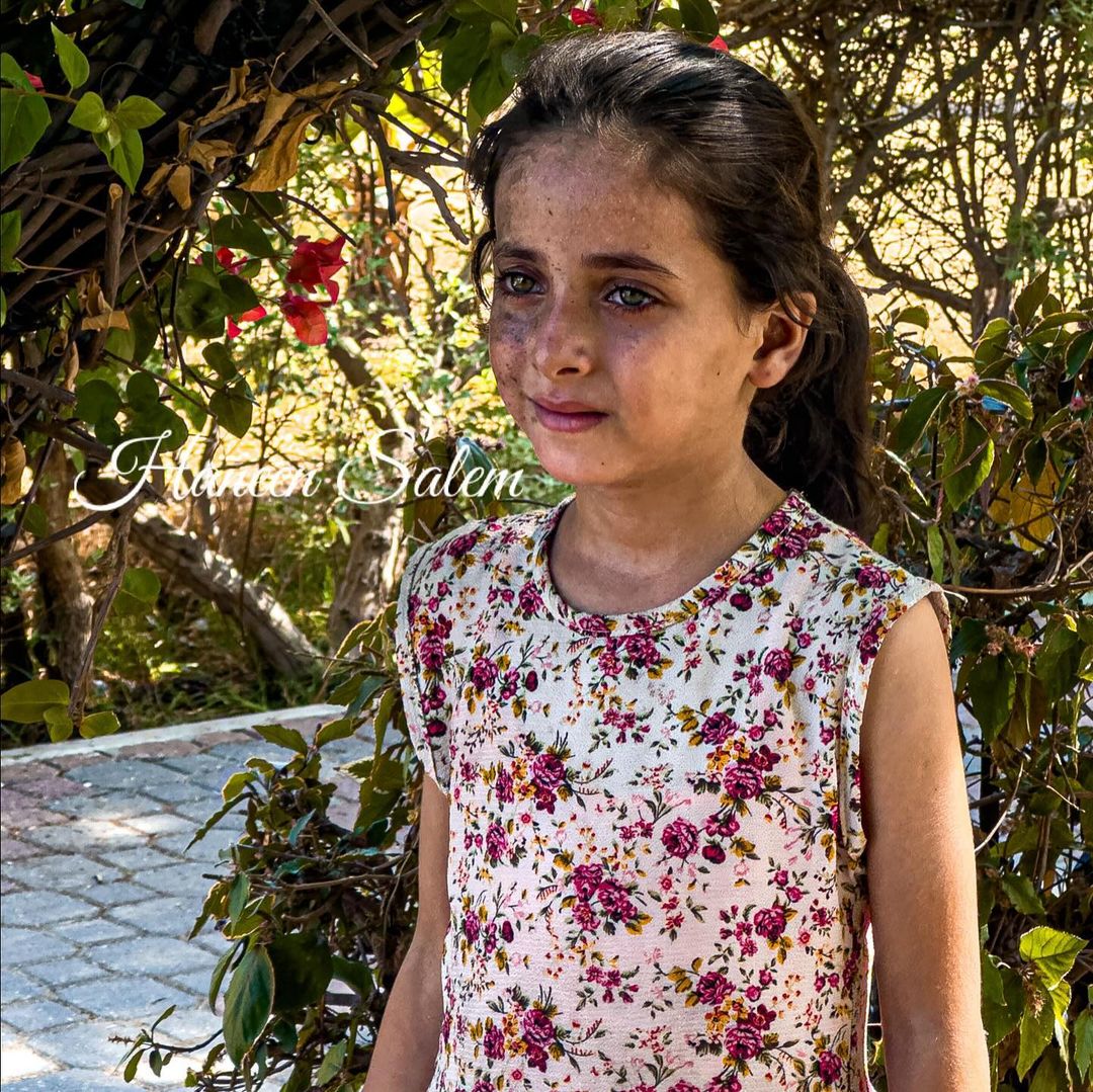 Palestinian Girl Maha Bears Burn Scars from Gaza Conflict