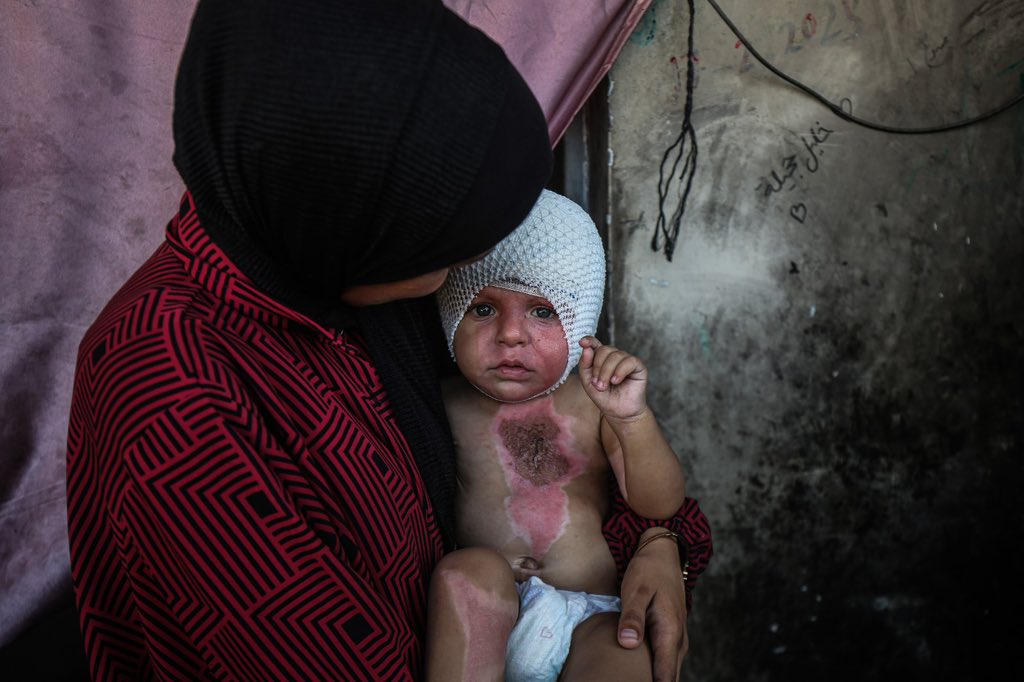 One-year-old baby Mohammad injured in Israeli bombing of Gaza school