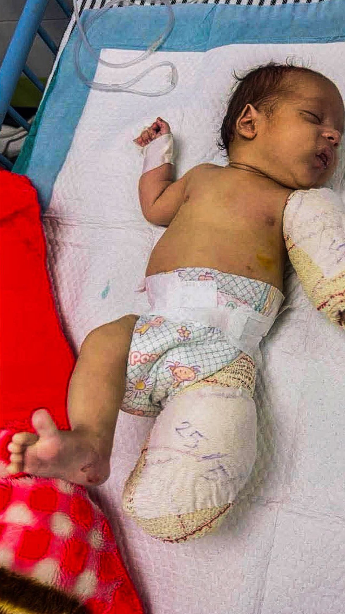 Infant Mohammed Al-Khatib loses mother, limbs in Israeli strike on tent