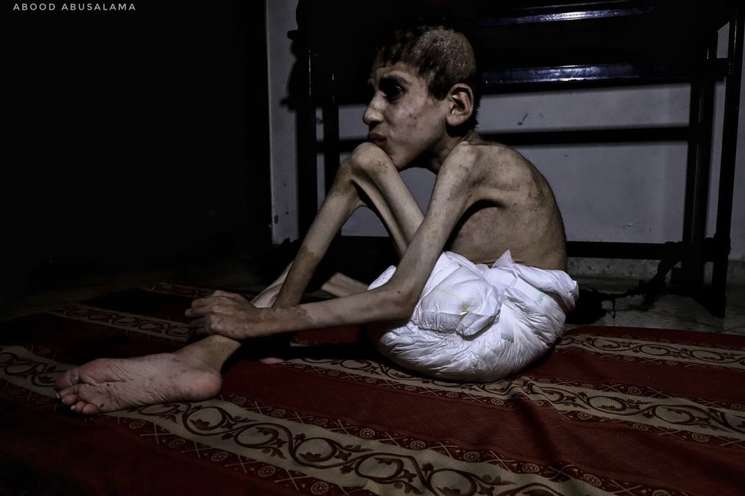 Palestinian Child Suffering from Malnutrition and Hepatitis in Gaza