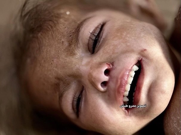 Critical Health Crisis: 4-Year-Old Child Needs Urgent Medical Referral